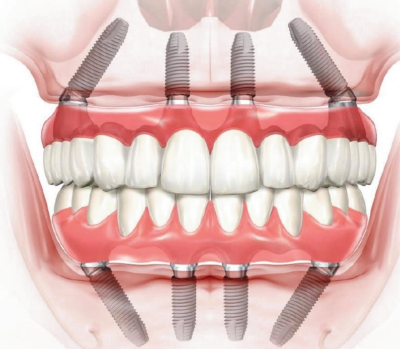 Имплантация по системе «ALL-ON-4»: Революционный Подход к Зубным Имплантам
