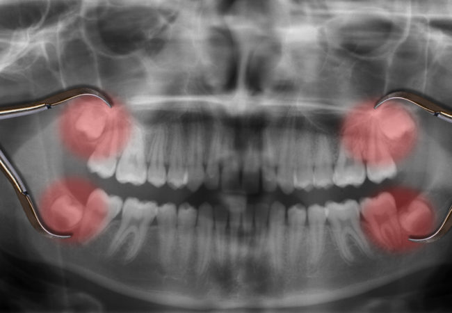 Удаление зубов в Днепре - что это такое?