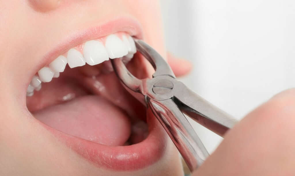Хирургическая стоматология по ОМС - можно ли удалить зуб бесплатно?