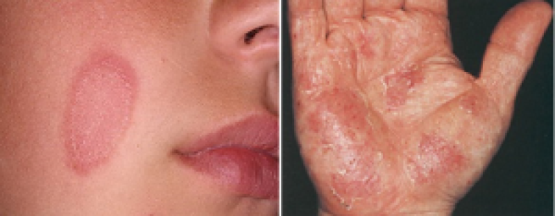 Погружение в мир кожных заболеваний: дерматомикоз