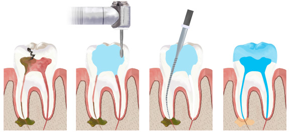 Качественное лечение зубов. Съемные протезы на передние зубы