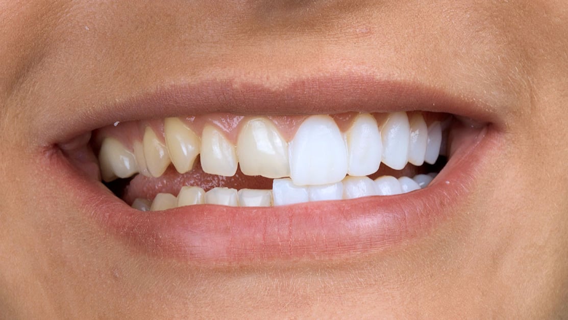 Виниры: как проходит процесс установки и как выбрать стоматолога