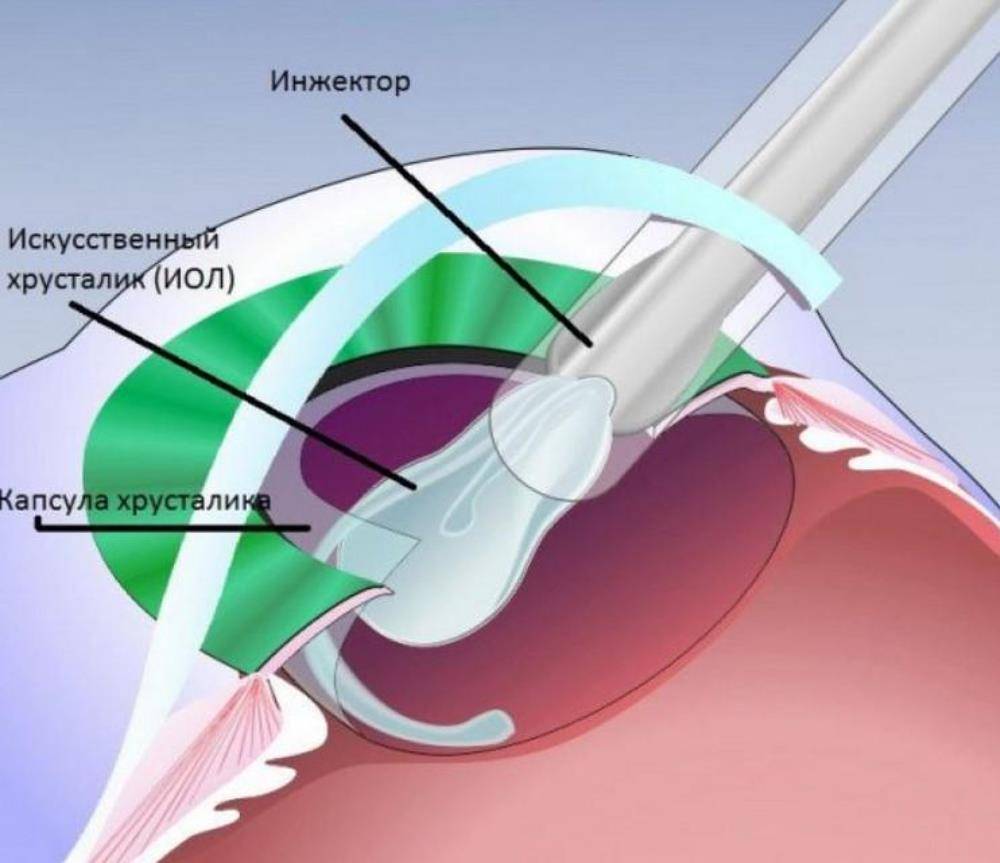 Факоэмульсификация: революционный метод лечения катаракты