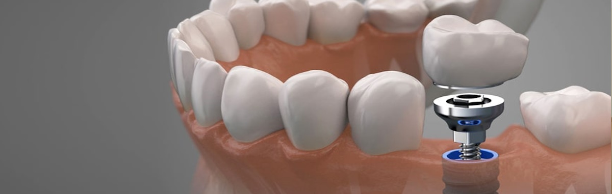 Имплантация зубов: без страха и боли