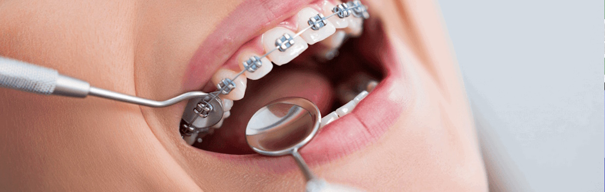 Лечение зубов на брекетах: металл или керамика