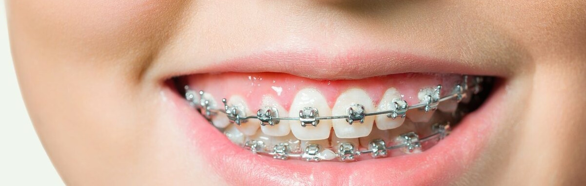 Причины роста популярности металлических брекетов