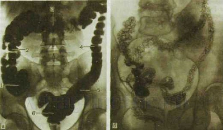 Рентген с контрастом в виде бария