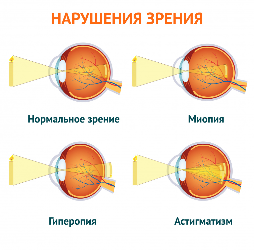Определение остроты зрения