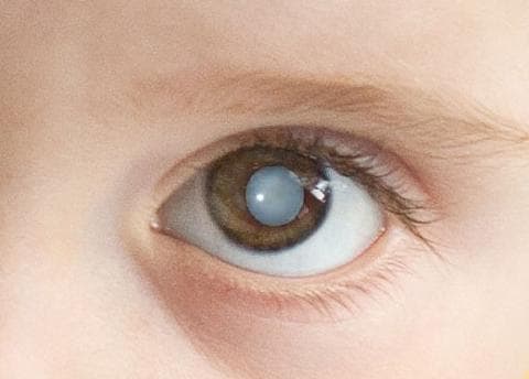 Врождённая или приобретённая катаракта — достаточно распространённое детское заболевание.