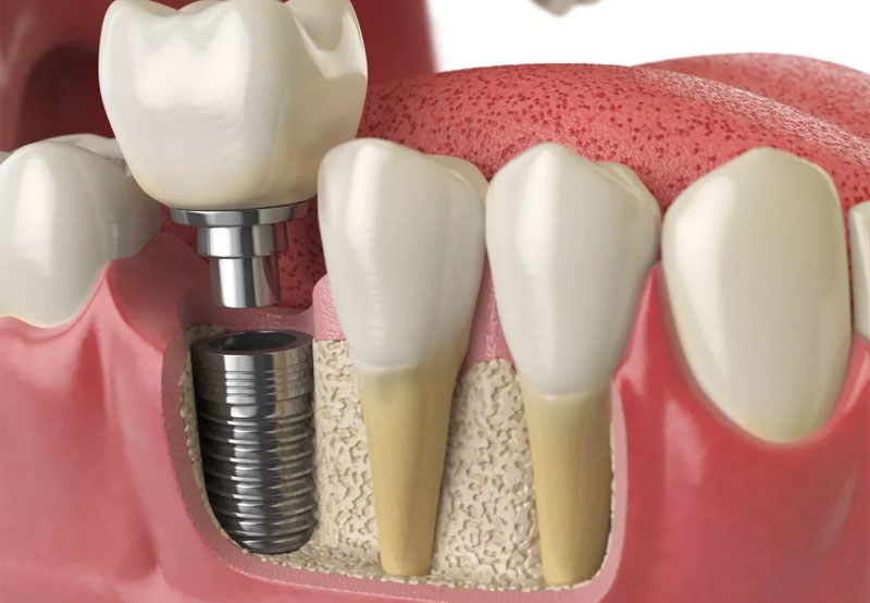 Имплантация Зубов: Восстановление Улыбки и Качества Жизни