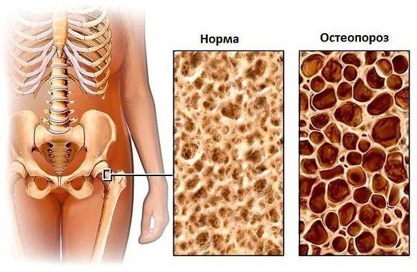 Что такое остеопороз, и какое лекарство помогает бороться с этим заболеванием